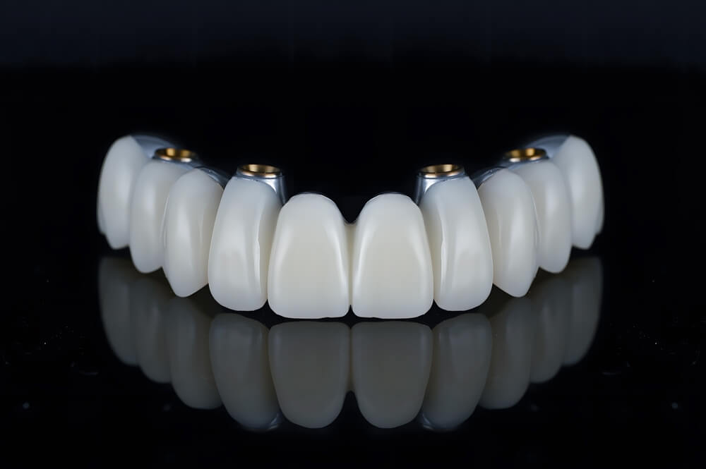 all on 4 pearly white dental implants ready to be put to use